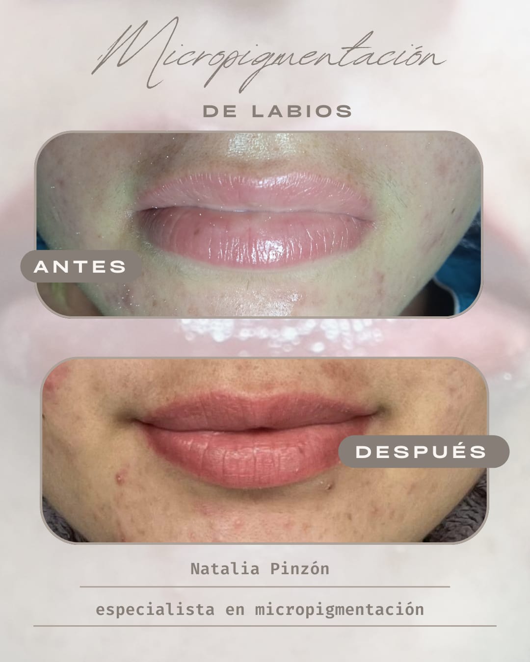 Labios pigmentados natural en Popayán